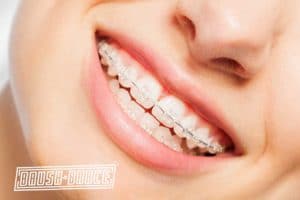 picture of a girl with clarity braces