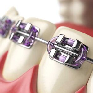 how much do braces cost